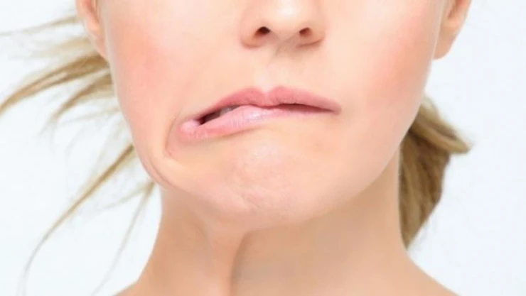 Uzmanından yüz felcine karşı öneriler